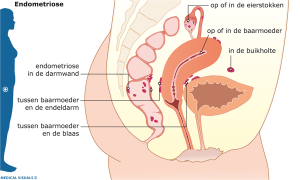 voeding-endometriose-online-dietist-about-health